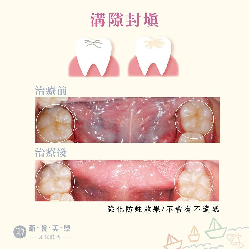 兒童蛀牙怎麼辦？家長必看完整指南