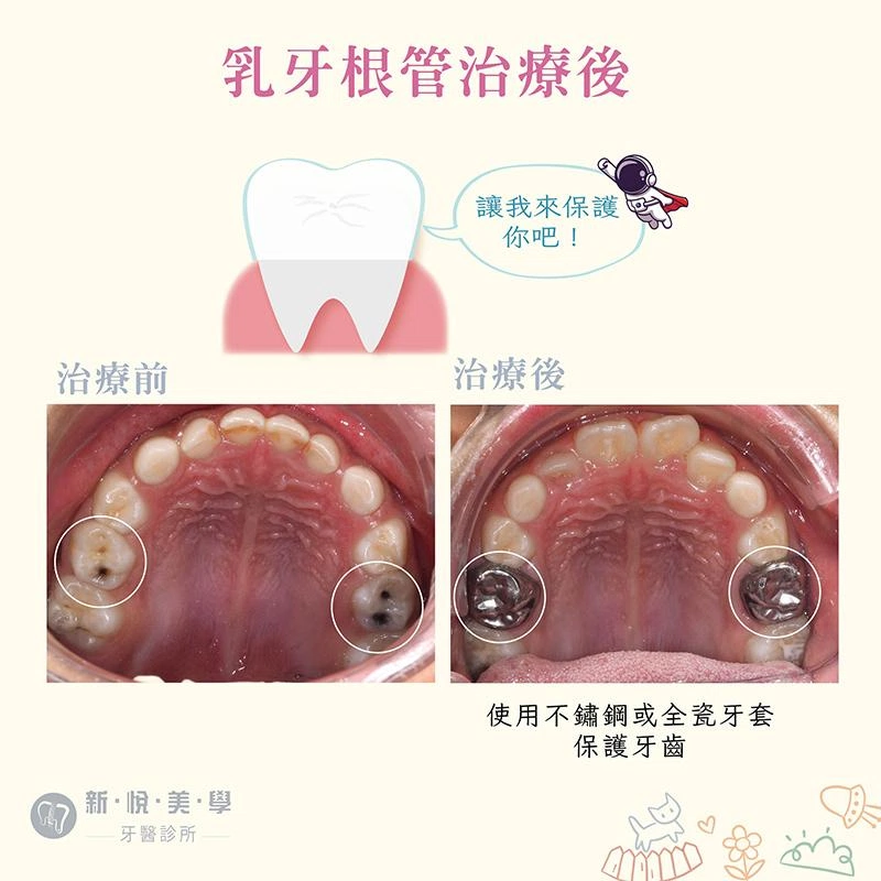 兒童蛀牙怎麼辦？家長必看完整指南