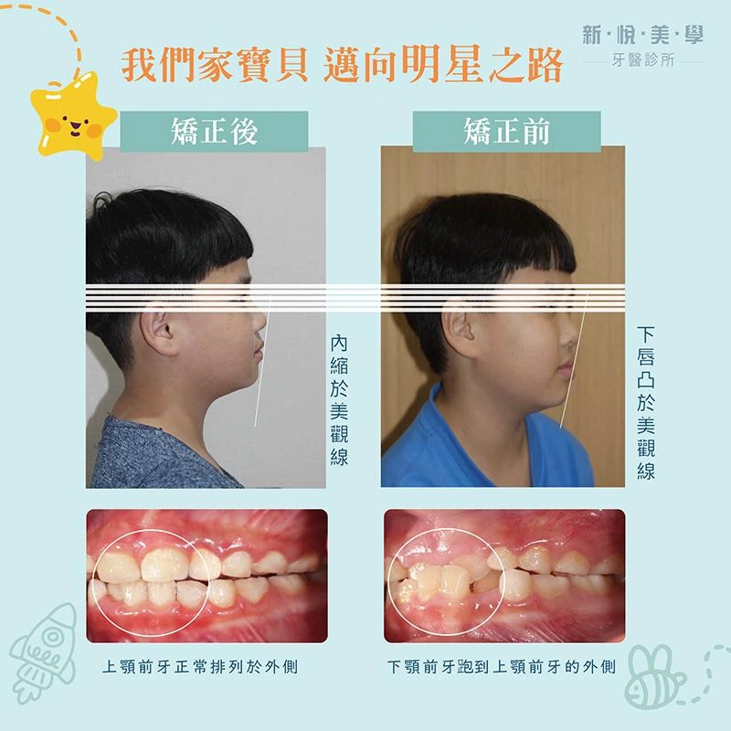 前牙錯咬與戽斗兒童早期矯正全攻略