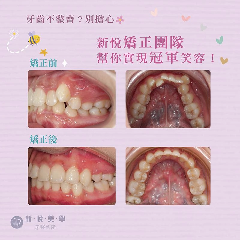 小學田徑明星的煩惱，從牙齒困擾到自信笑容