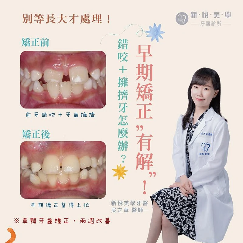 早期矯正有解，錯咬+擁擠牙怎麼辦?