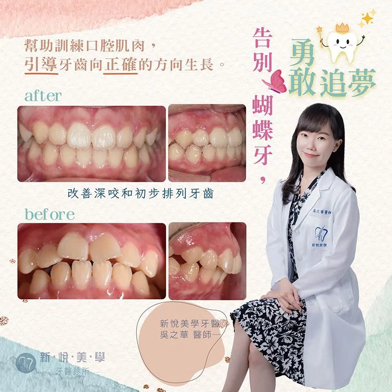 深咬、牙齒亂、擺脫「蝴蝶牙」從害羞到自信笑容
