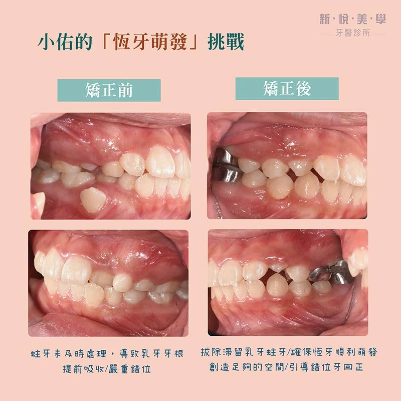 小佑的牙齒成長挑戰：早期矯正如何扭轉劣勢？
