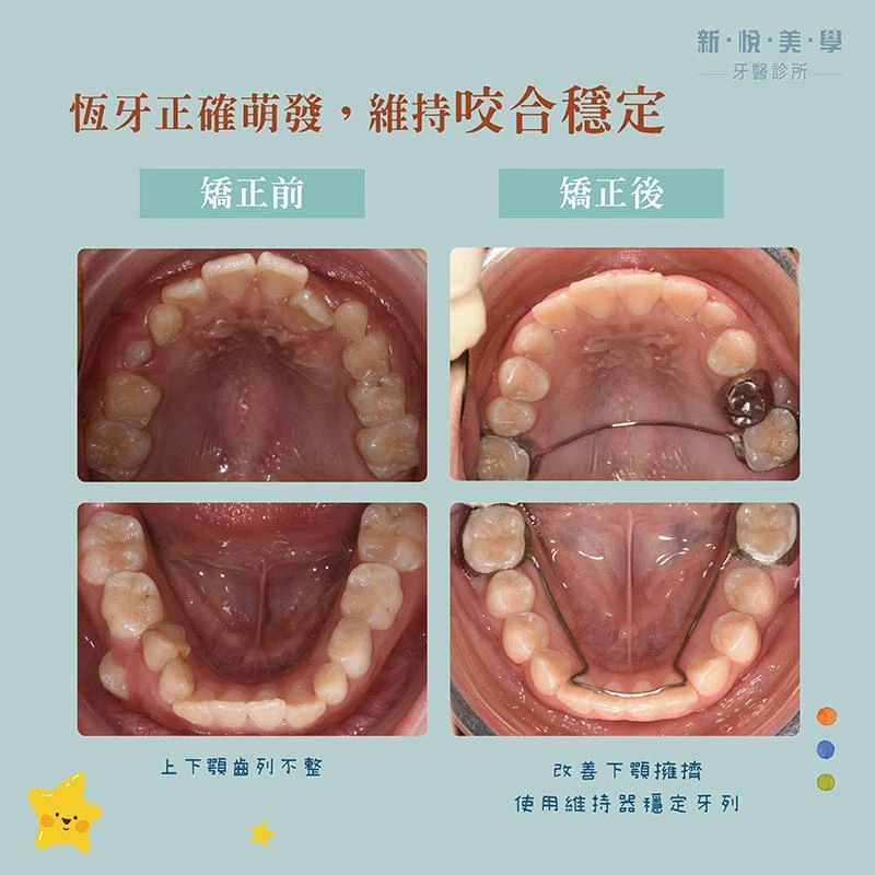 小佑的牙齒成長挑戰：早期矯正如何扭轉劣勢？