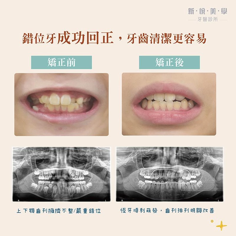 小佑的牙齒成長挑戰：早期矯正如何扭轉劣勢？