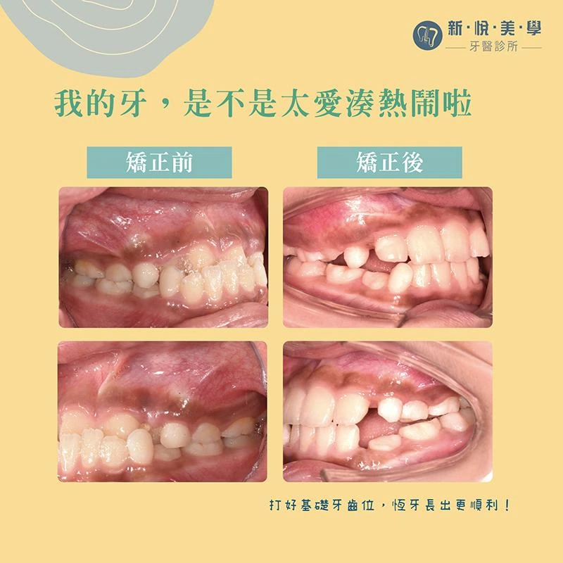 孩子的第一場矯正旅程，就從這顆多生牙開始！