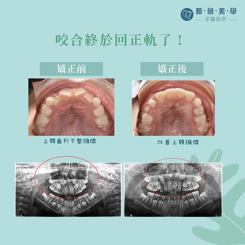 孩子的第一場矯正旅程，就從這顆多生牙開始！