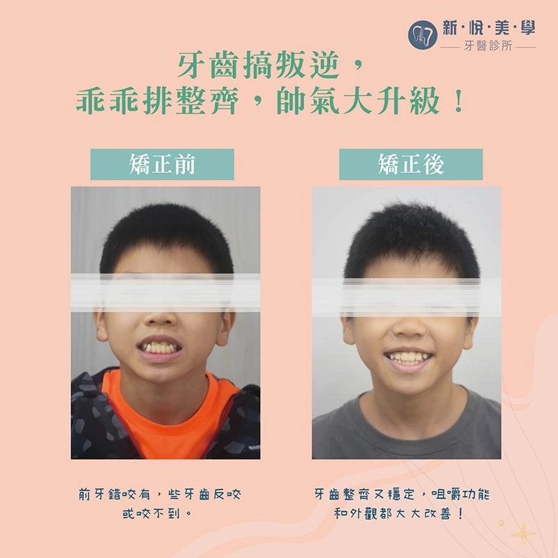 孩子的第一場矯正旅程，就從這顆多生牙開始！