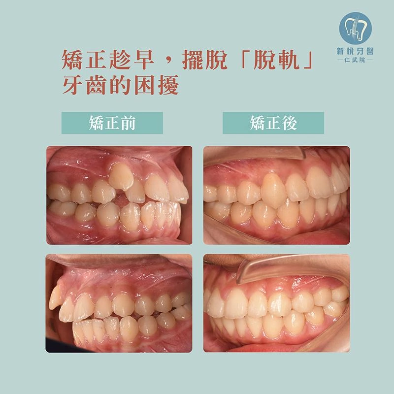 8–12 歲早期矯正如何避免未來複雜治療？