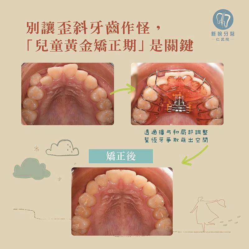 8–12 歲早期矯正如何避免未來複雜治療？