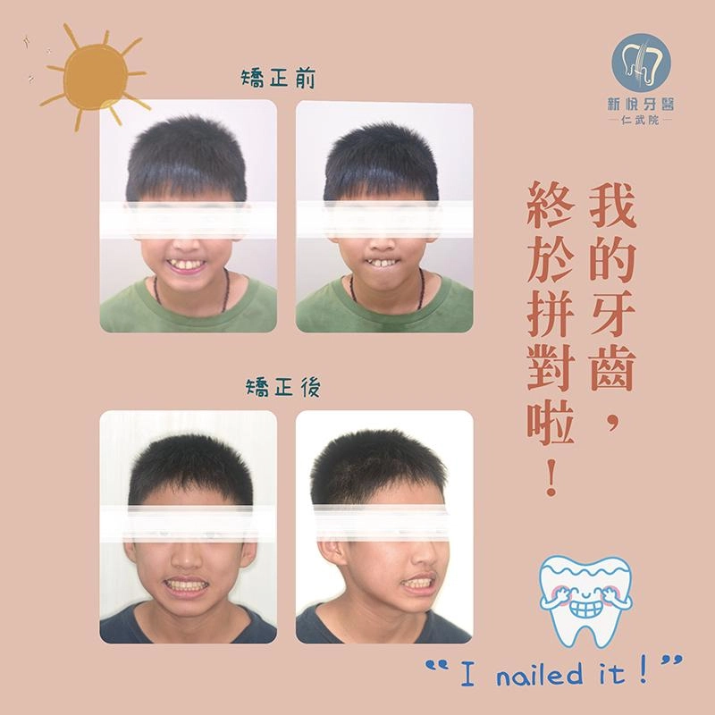 8–12 歲早期矯正如何避免未來複雜治療？