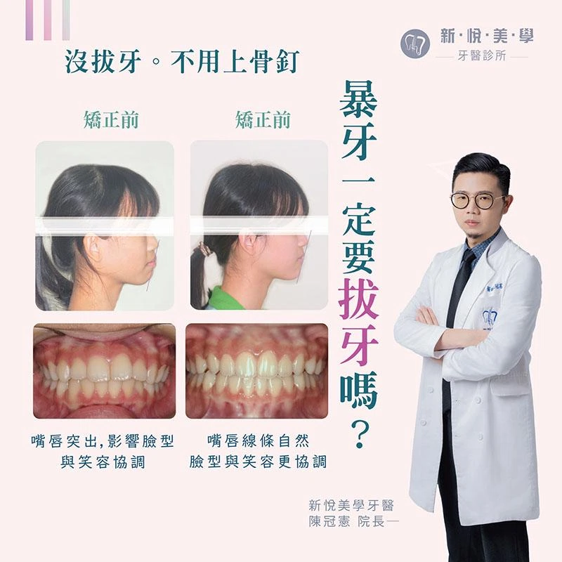 不用拔牙也能變美！隱形矯正魔法