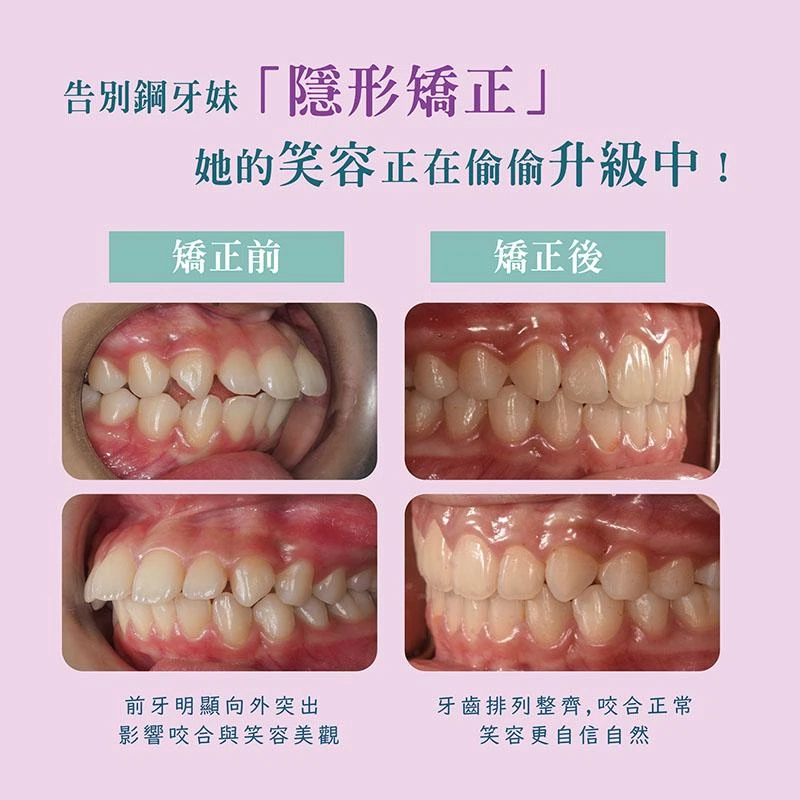 不用拔牙也能變美！隱形矯正魔法