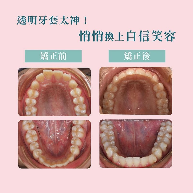 不用拔牙也能變美！隱形矯正魔法