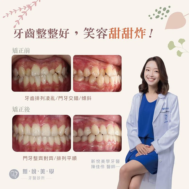 骨骼性戽斗矯正案例分享，找回自信笑容的改變之路