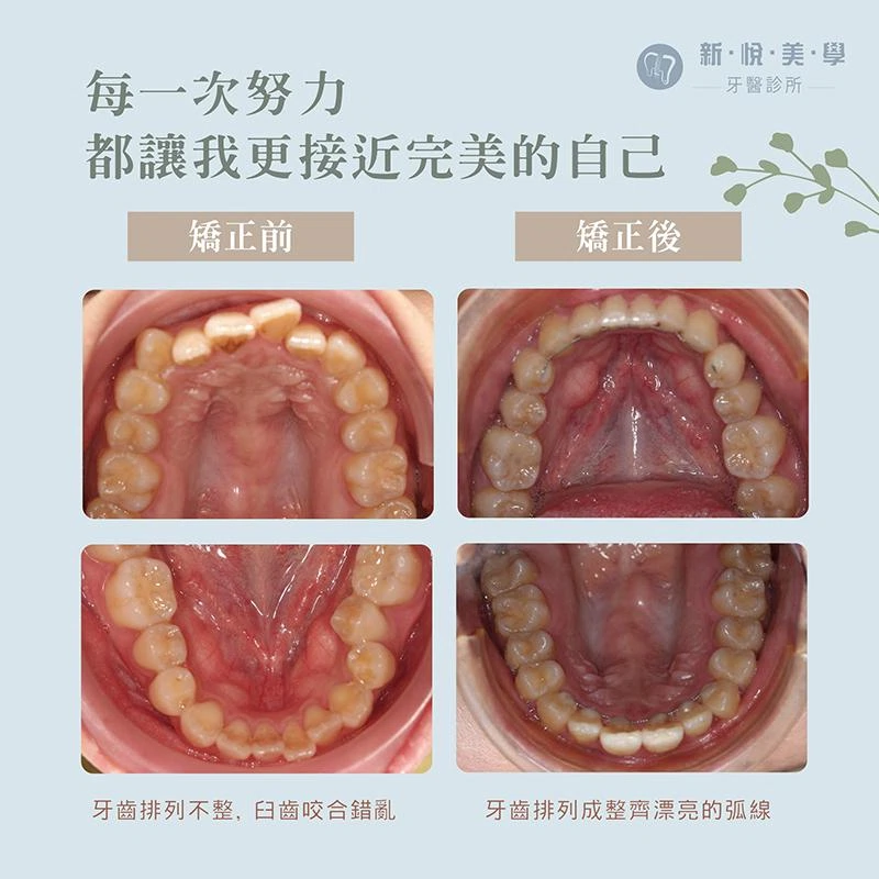 骨骼性戽斗矯正案例分享,找回自信笑容的改變之路 骨骼性戽斗矯正案例分享,找回自信笑容的改變之路