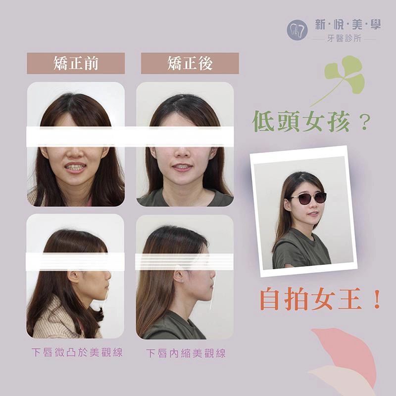 骨骼性戽斗矯正案例分享,找回自信笑容的改變之路 骨骼性戽斗矯正案例分享,找回自信笑容的改變之路