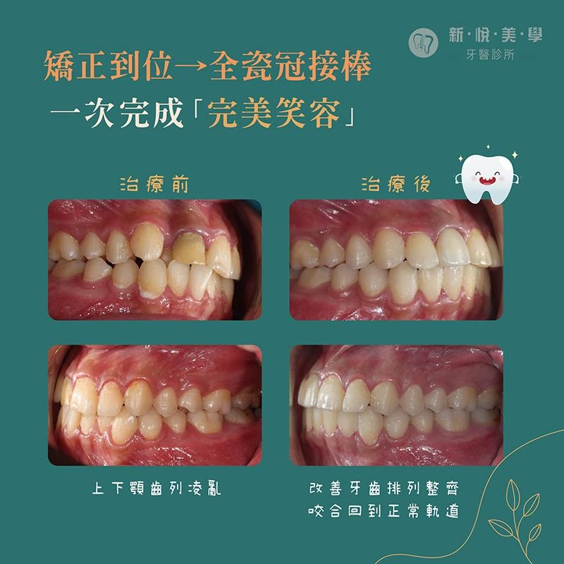 笑容卡卡？矯正＋全瓷冠，牙齒到位笑容回來！