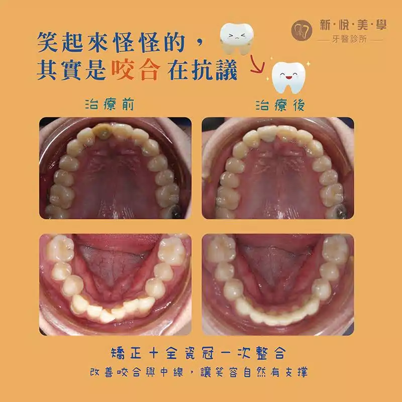 笑容卡卡？矯正＋全瓷冠，牙齒到位笑容回來！
