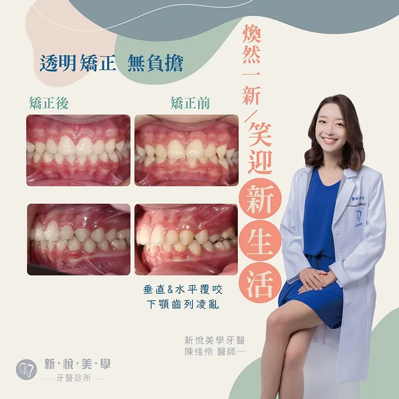 透明牙套矯正優點大公開，沒人看得出來的自信蛻變