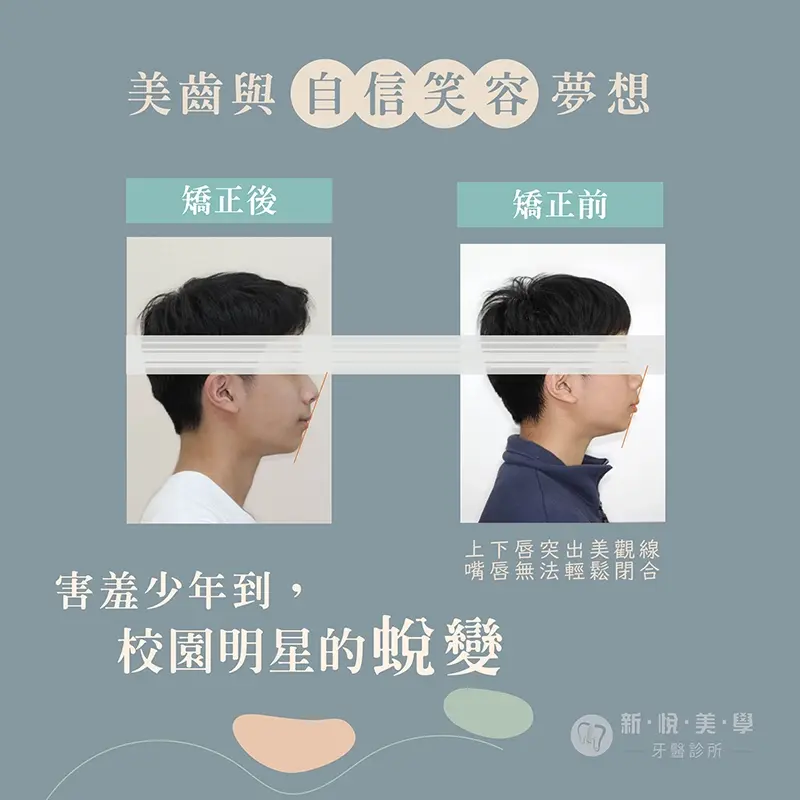 透明牙套矯正優點大公開，沒人看得出來的自信蛻變