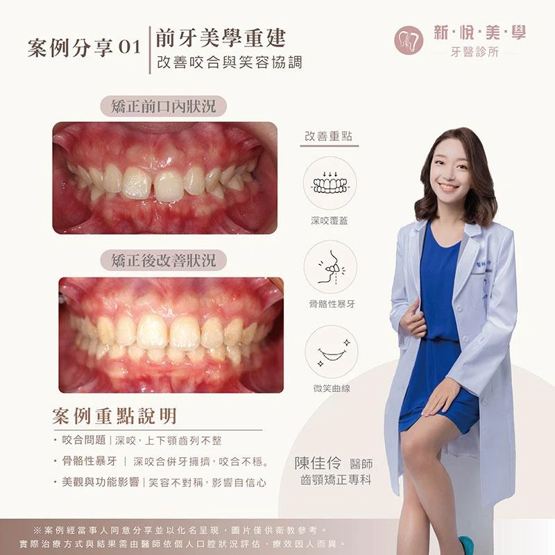 骨骼性暴牙矯正案例｜改善嘴凸、深咬與牙齒擁擠，找回自然笑容