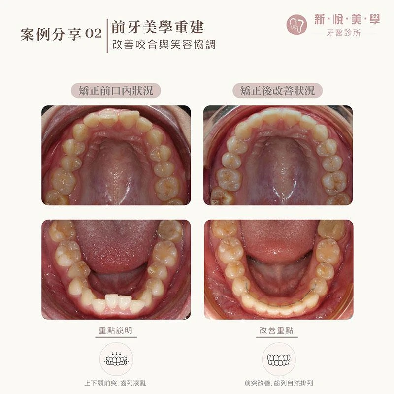 骨骼性暴牙矯正案例|改善嘴凸、深咬與牙齒擁擠,找回自然笑容 骨骼性暴牙矯正案例|改善嘴凸、深咬與牙齒擁擠,找回自然笑容