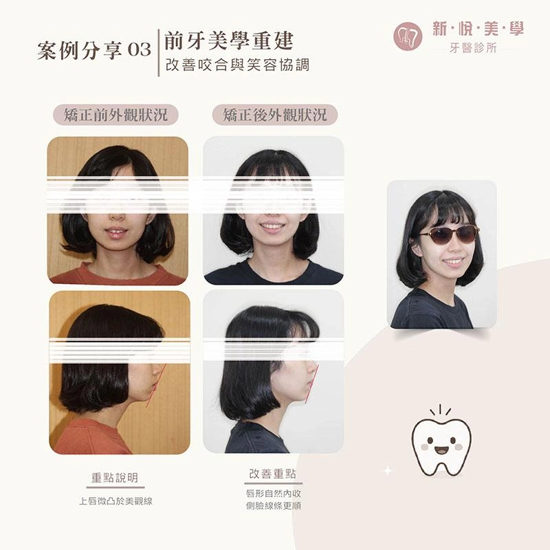 骨骼性暴牙矯正案例|改善嘴凸、深咬與牙齒擁擠,找回自然笑容 骨骼性暴牙矯正案例|改善嘴凸、深咬與牙齒擁擠,找回自然笑容