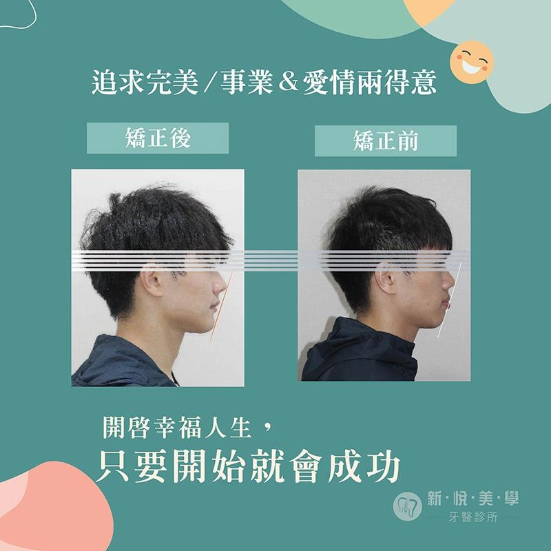 承翔的幸福人生劇本，矯正牙齒 開啟成功之路