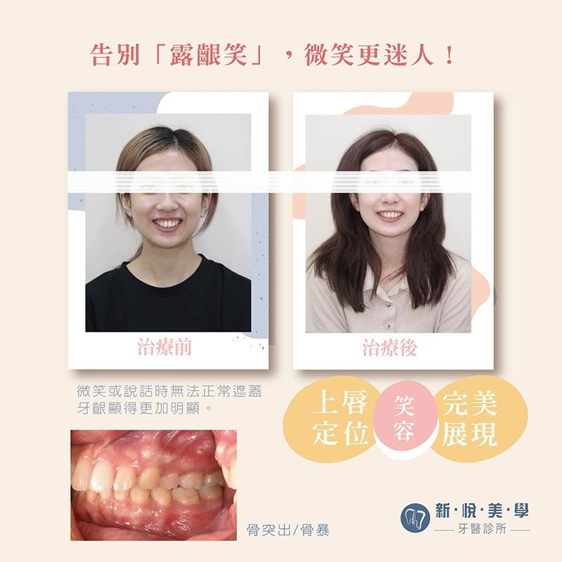 牙齦不再搶鏡,笑容更聚焦! 牙齦不再搶鏡,笑容更聚焦!