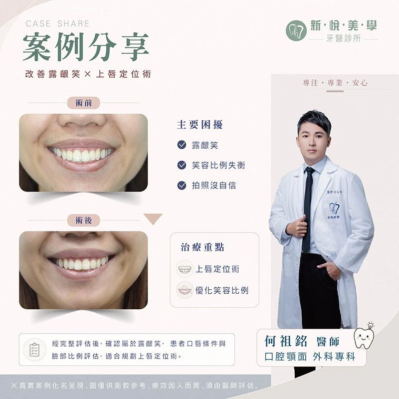 露齦笑怎麼改善？上唇定位術適合哪些人？從笑容比例了解露齦笑改善方式