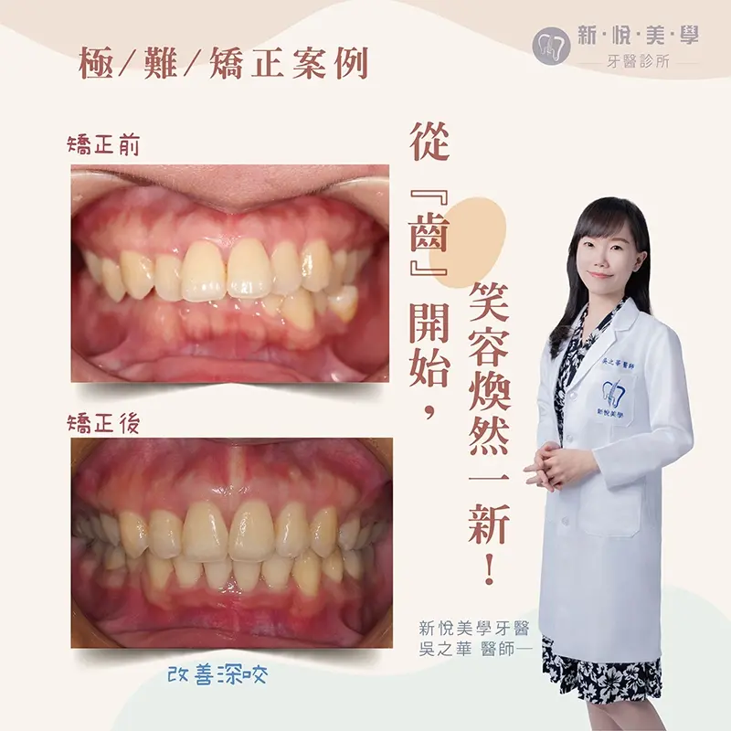 極難矯正案例｜齒在必得！