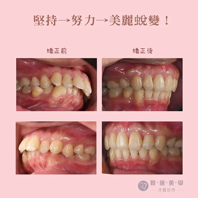 極難矯正案例|齒在必得! 極難矯正案例|齒在必得!