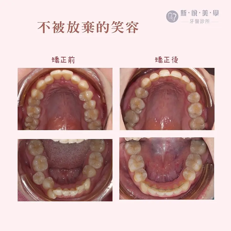 極難矯正案例|齒在必得! 極難矯正案例|齒在必得!
