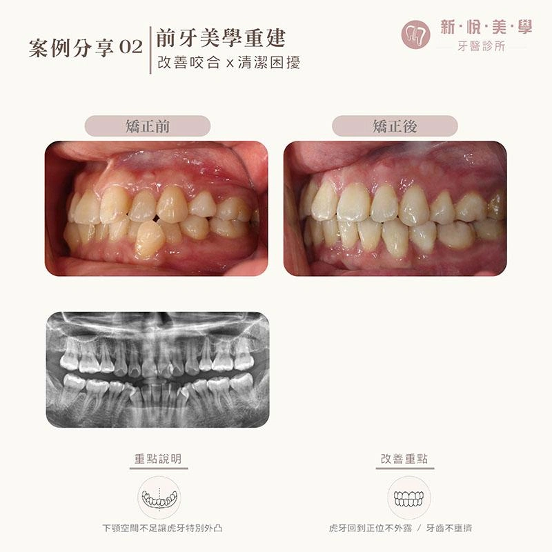 牙齒擁擠、虎牙外凸怎麼辦?成人拔牙矯正案例 牙齒擁擠、虎牙外凸怎麼辦?成人拔牙矯正案例