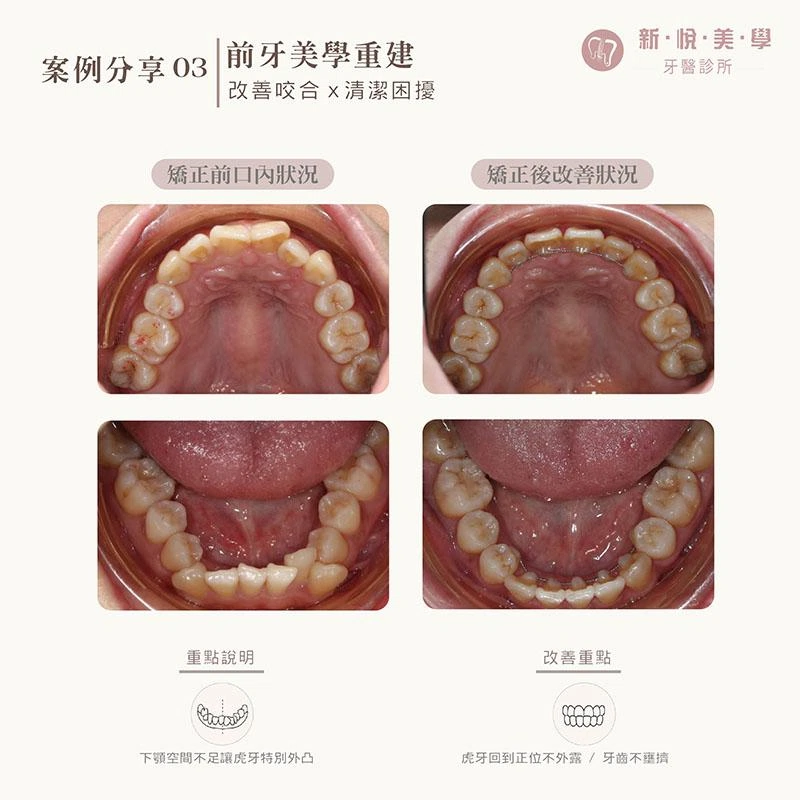 牙齒擁擠、虎牙外凸怎麼辦?成人拔牙矯正案例 牙齒擁擠、虎牙外凸怎麼辦?成人拔牙矯正案例