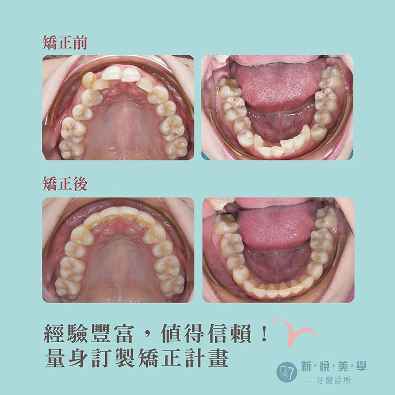 複雜牙齒問題？困難案例新悅陪妳實現"完美"