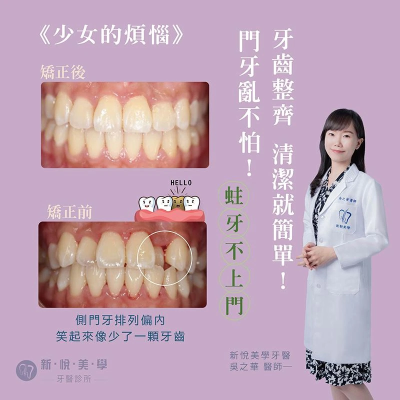 《萱少女的煩惱》解決門牙內縮、清潔困難與蛀牙困擾