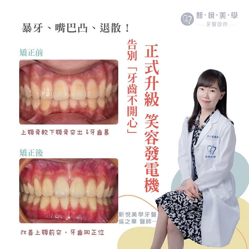 大學生牙齒暴、嘴巴凸怎麼辦？如何改善？實際案例解析