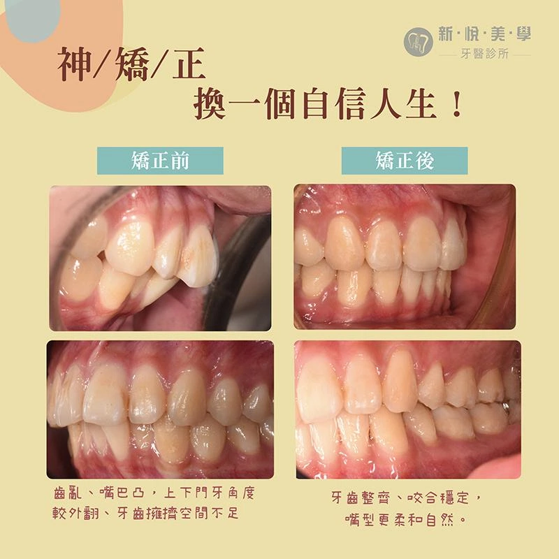 大學生牙齒暴、嘴巴凸怎麼辦?如何改善?實際案例解析 大學生牙齒暴、嘴巴凸怎麼辦?如何改善?實際案例解析