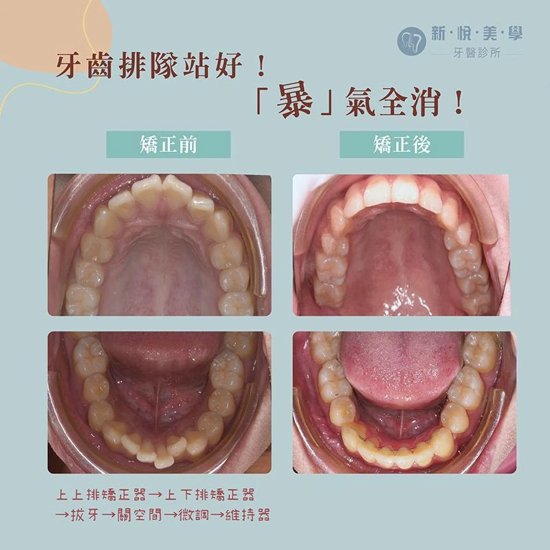 大學生牙齒暴、嘴巴凸怎麼辦?如何改善?實際案例解析 大學生牙齒暴、嘴巴凸怎麼辦?如何改善?實際案例解析