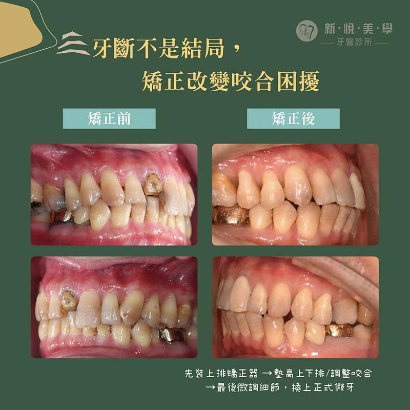 牙齒要耐用,關鍵不只是假牙,而是咬合 牙齒要耐用,關鍵不只是假牙,而是咬合