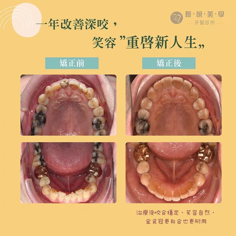 牙齒要耐用,關鍵不只是假牙,而是咬合 牙齒要耐用,關鍵不只是假牙,而是咬合