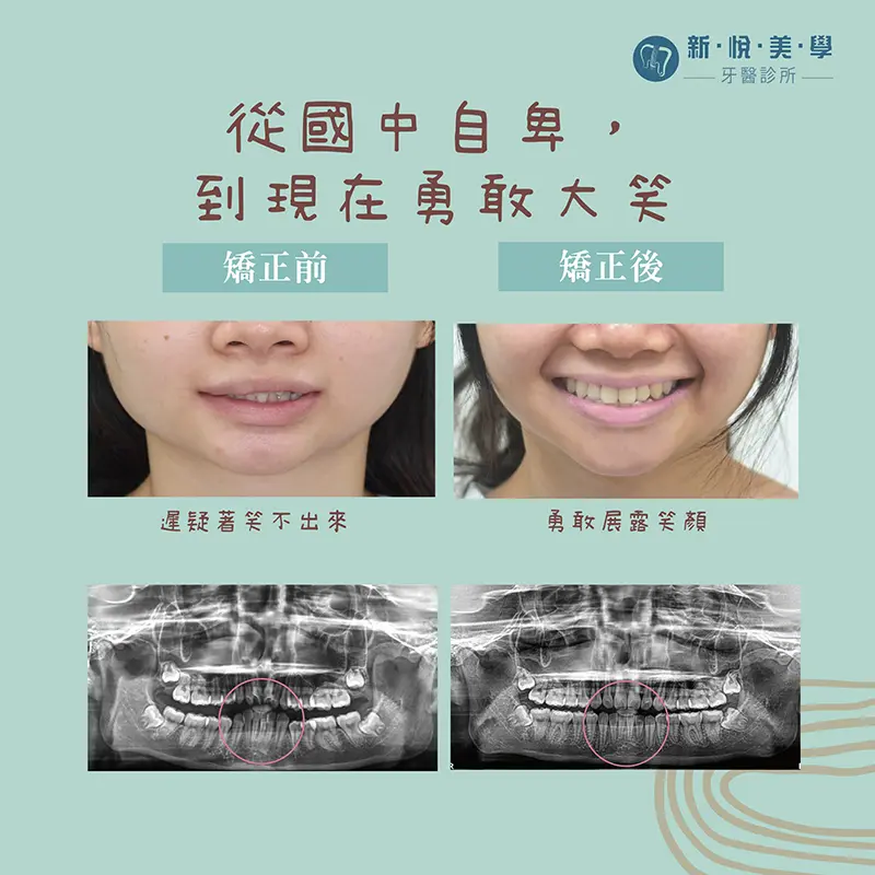 透明牙套矯正,我偷偷開始了牙齒矯正,沒人發現 透明牙套矯正,我偷偷開始了牙齒矯正,沒人發現