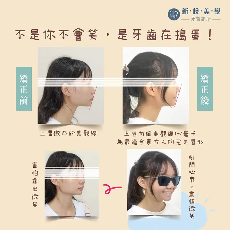 透明牙套矯正,我偷偷開始了牙齒矯正,沒人發現 透明牙套矯正,我偷偷開始了牙齒矯正,沒人發現