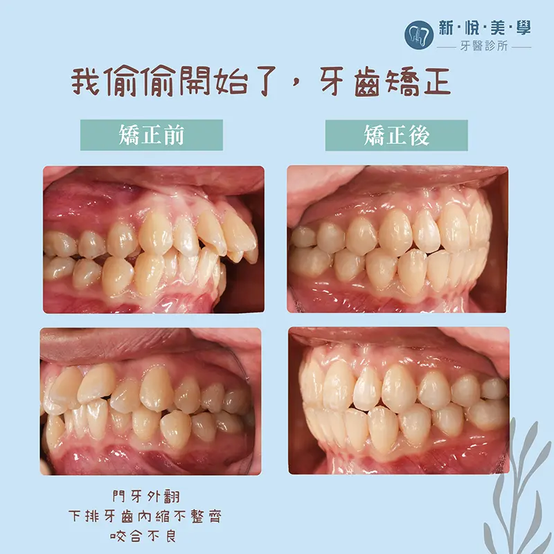 透明牙套矯正,我偷偷開始了牙齒矯正,沒人發現 透明牙套矯正,我偷偷開始了牙齒矯正,沒人發現