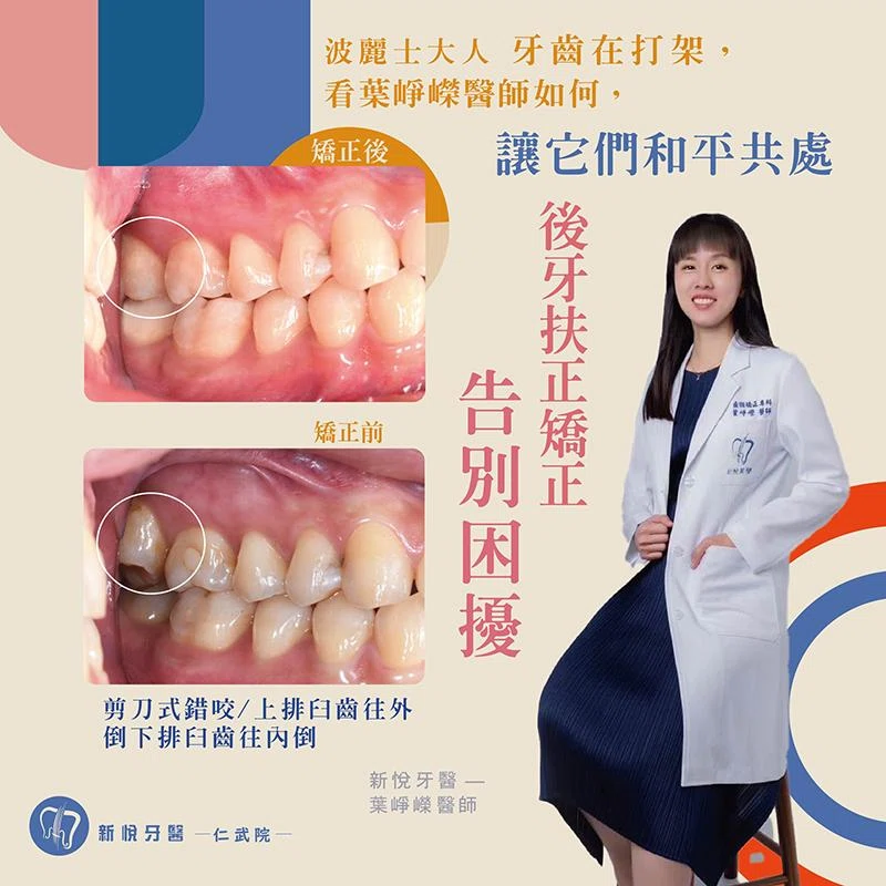 波麗士大人牙齒在打架，後牙扶正告別困擾