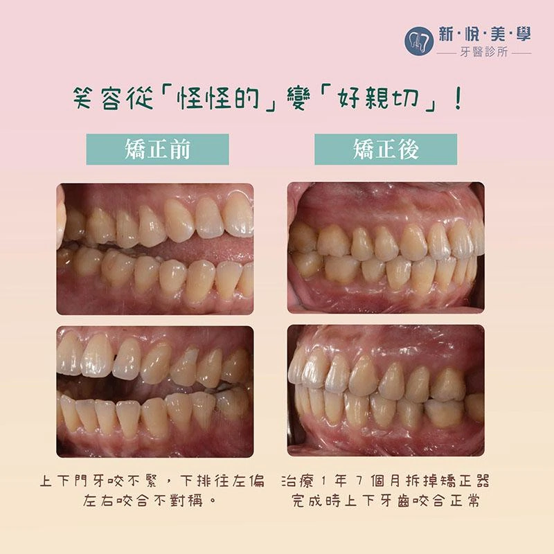 不用手術改善開咬難題 不用手術改善開咬難題