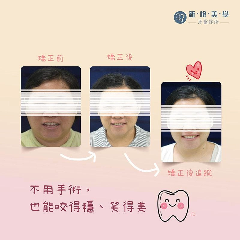 不用手術改善開咬難題 不用手術改善開咬難題