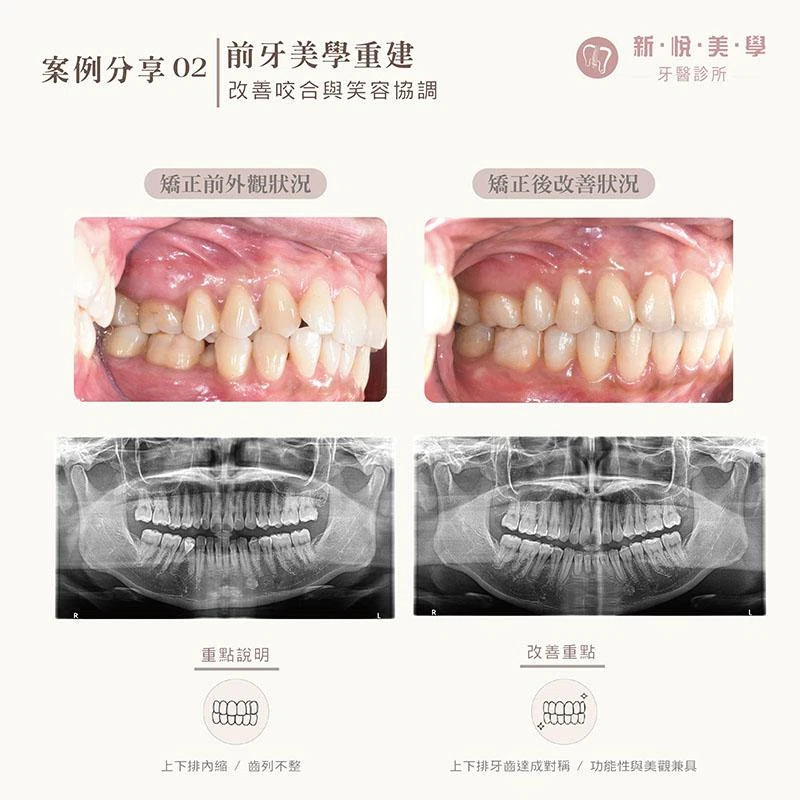 不拔牙矯正可以改善下排牙齒內縮嗎?戴蒙矯正案例分享 不拔牙矯正可以改善下排牙齒內縮嗎?戴蒙矯正案例分享